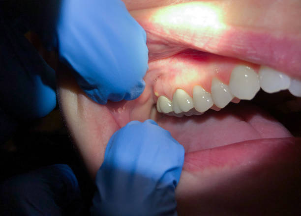 Best Emergency Wisdom Tooth Extraction in Bethpage, NY